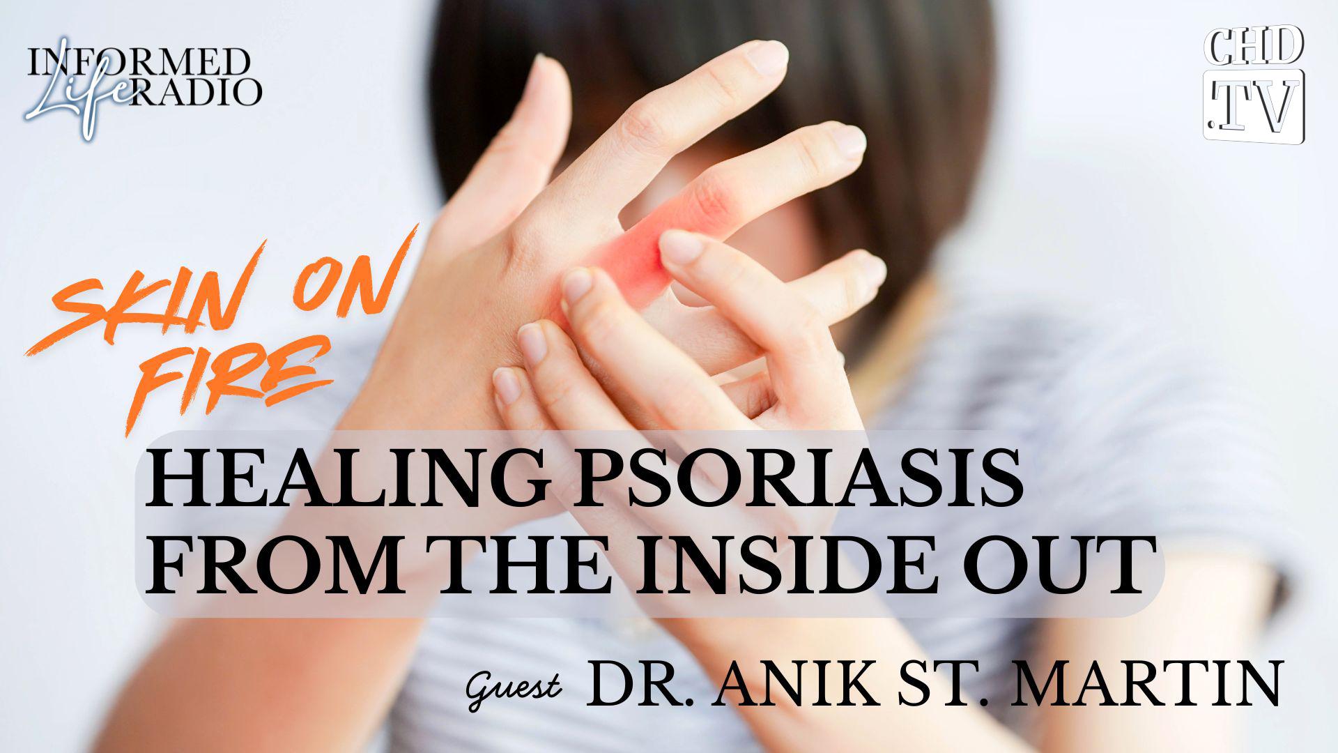 Skin on Fire: Healing Psoriasis From the Inside Out